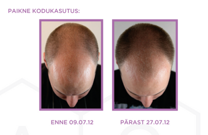 AQ Advanced Hair Complex+, 5 × 6 ml